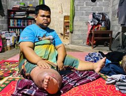 Di Tengah Perjuangan Melawan Kaki Gajah, Syahrul Berharap Uluran Tangan untuk Operasi.